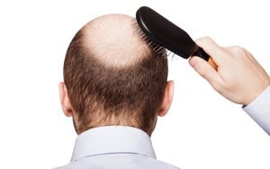 Alopecia masculina: consejos para tratarla en Centros Beltrán. En Centros Beltrán, somos especialistas en todo tipo de tratamientos capilares y queremos darte una serie de consejos para tratar la alopecia masculina. Si sufres este problema capilar toma nota y pon en práctica nuestras recomendaciones.