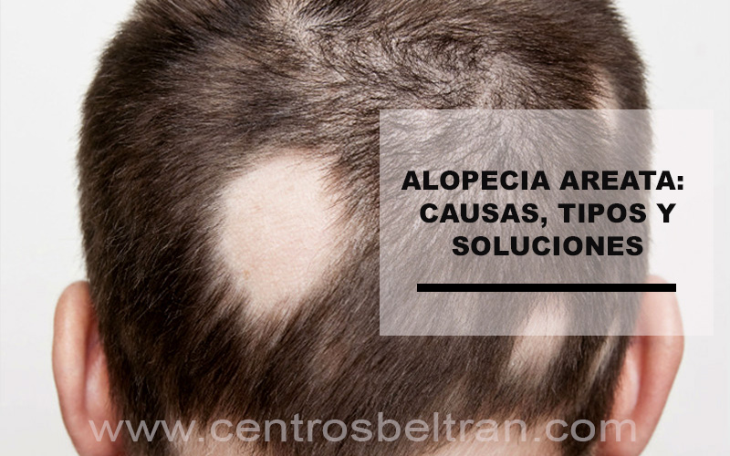 Alopecia areata: causas, tipos y soluciones