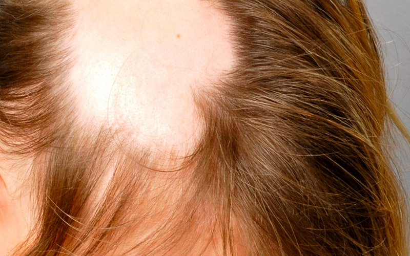 Alopecia cicatrizal: causas y soluciones. Según cada tipo de alopecia recomendamos una solución capilar u otra. En este artículo nos centraremos en las soluciones para la alopecia cicatrizal.