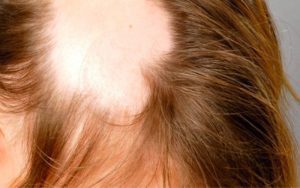 Alopecia cicatrizal: causas y soluciones