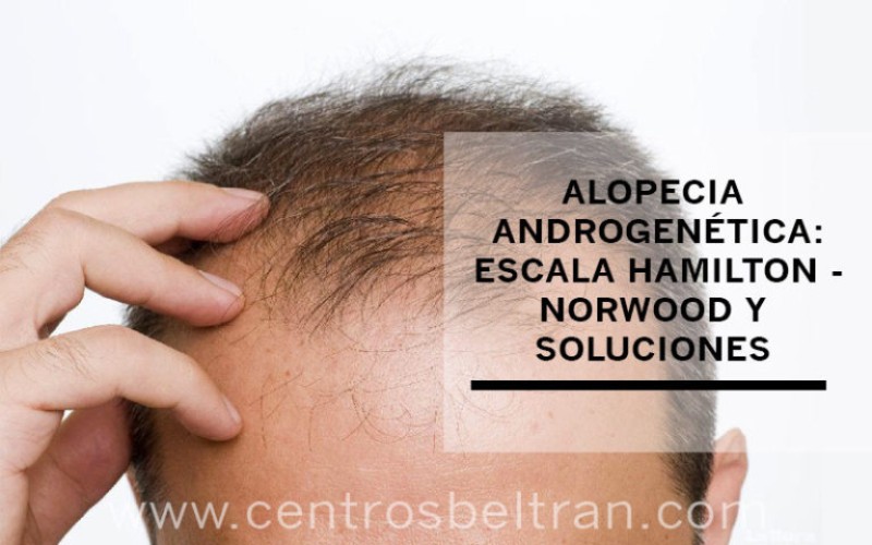 Alopecia androgenética escala de Hamilton-Norwood y soluciones