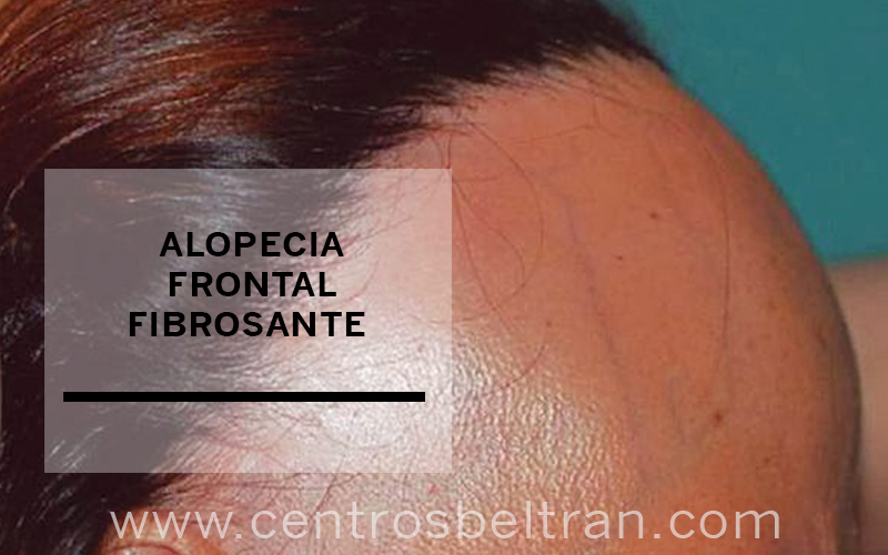 Todo sobre la alopecia frontal fibrosante. Cada vez son más las mujeres que ven cómo van perdiendo pelo poco a poco en la zona del nacimiento del cabello, tanto en la zona de la frente como en los laterales. Esta enfermedad capilar es conocida como alopecia frontal fibrosante. ¡Te contamos sus causas, cómo se produce y las posibles soluciones!