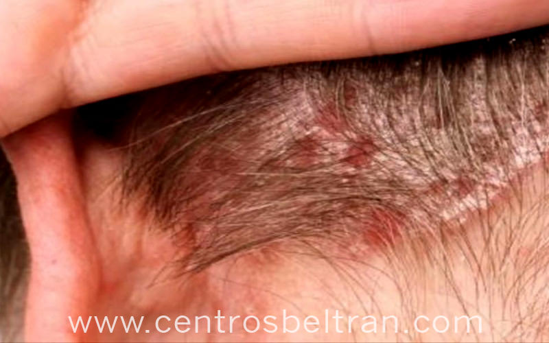 Calumnia Charles Keasing Posible Principales problemas del cuero cabelludo | Centros Beltrán