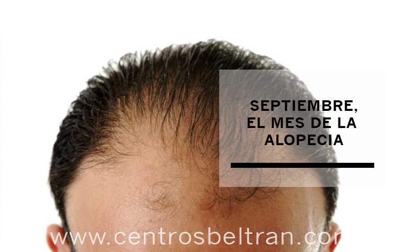 Septiembre, el mes de concienciación sobre la alopecia