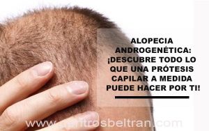 Prótesis capilares para alopecia androgenética