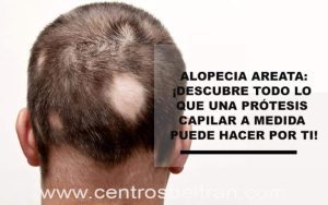 Solución capilar para alopecia areata