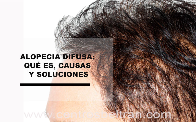 Alopecia difusa: qué es, causas y soluciones