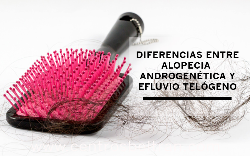 Diferencias entre alopecia androgenética y efluvio telógeno