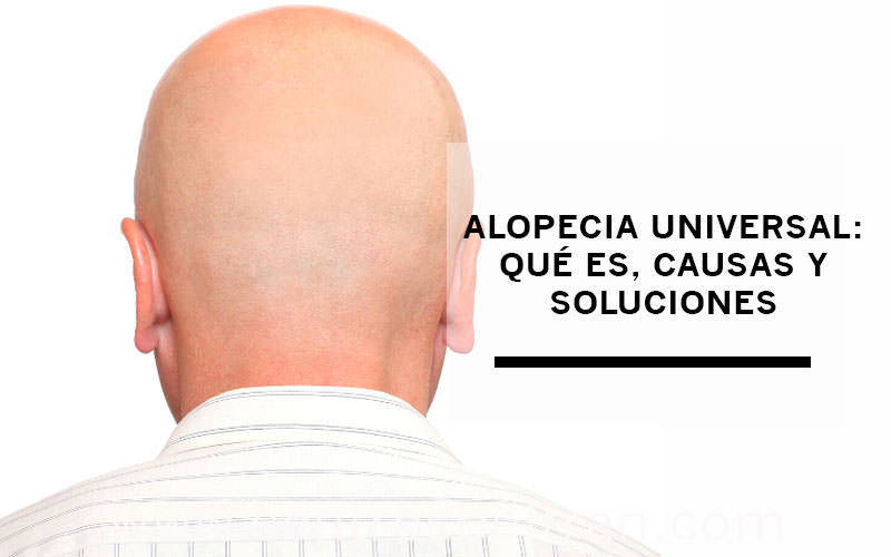 Alopecia universal: qué es, causas y soluciones